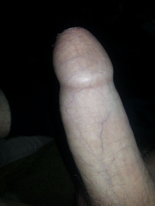 Erect2